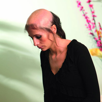 Superionix® vorher - Zweithaarberatung im Haarcenter Hess in Rosenheim